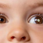 Retinoblastoma update